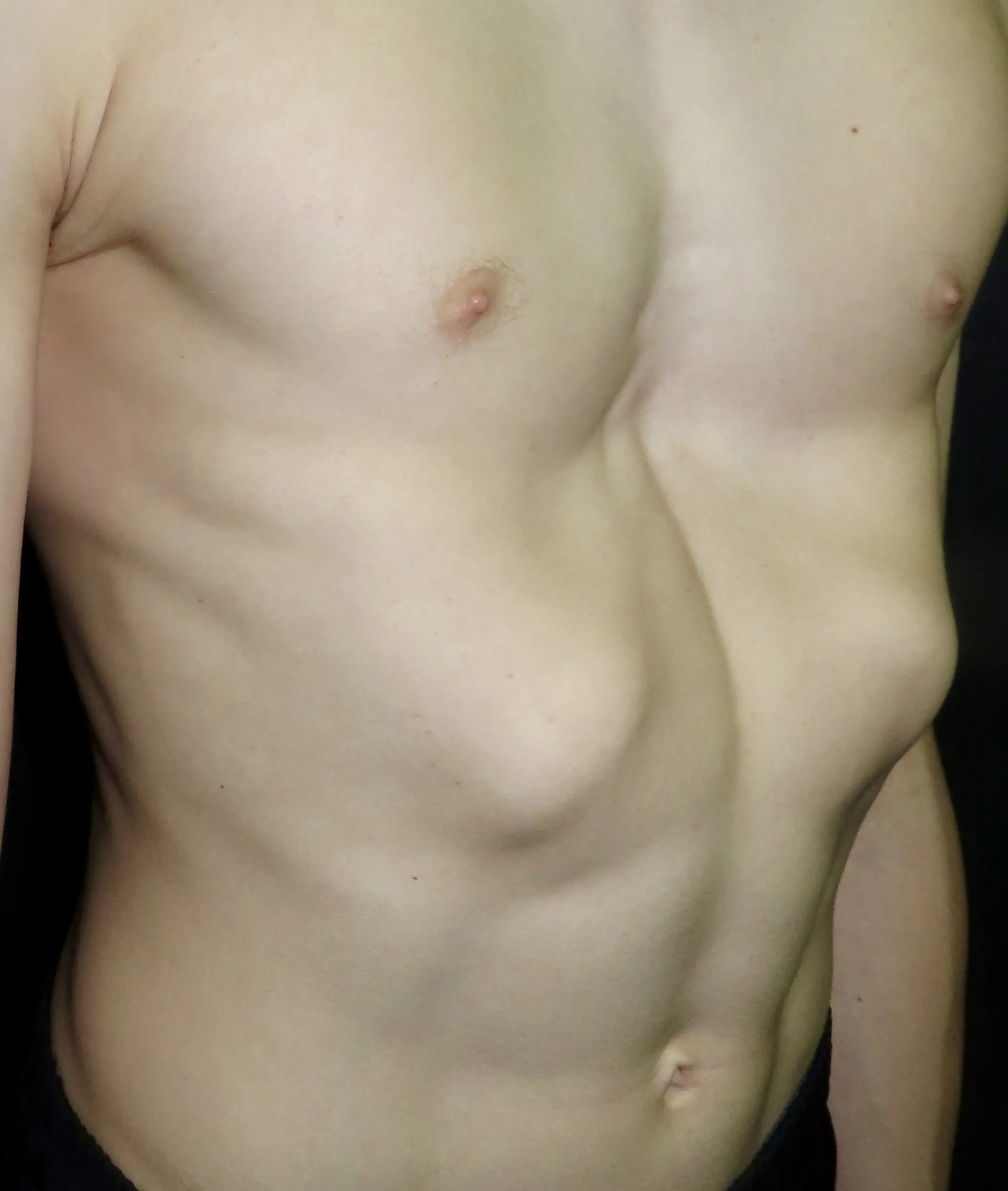 Rib Flare
