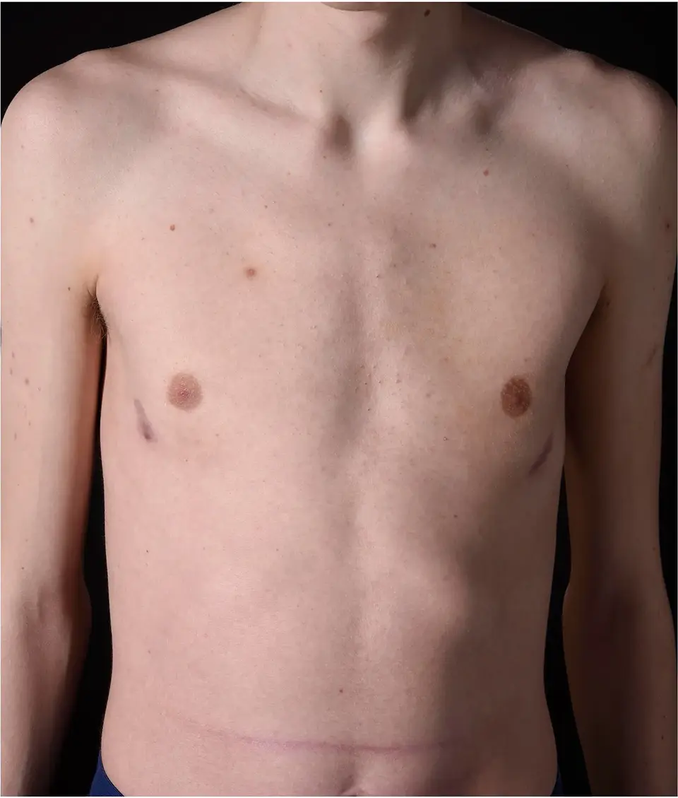 Pectus Bar Removal