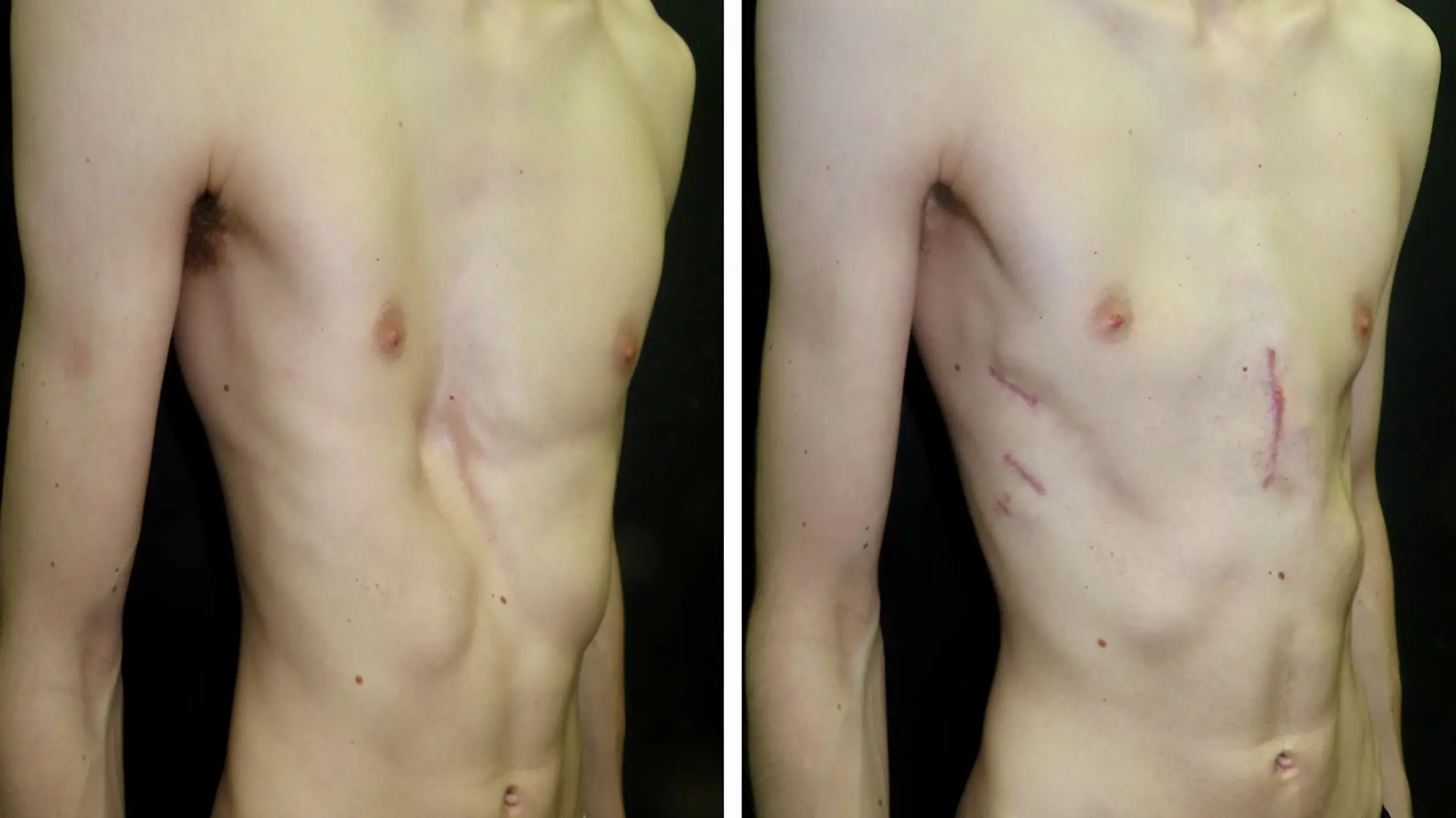 Hybrid & Combined Chest Wall Reconstruction