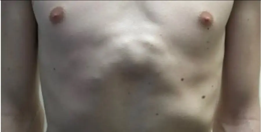 Mini-Ravitch hybrid procedure for pectus carinatum