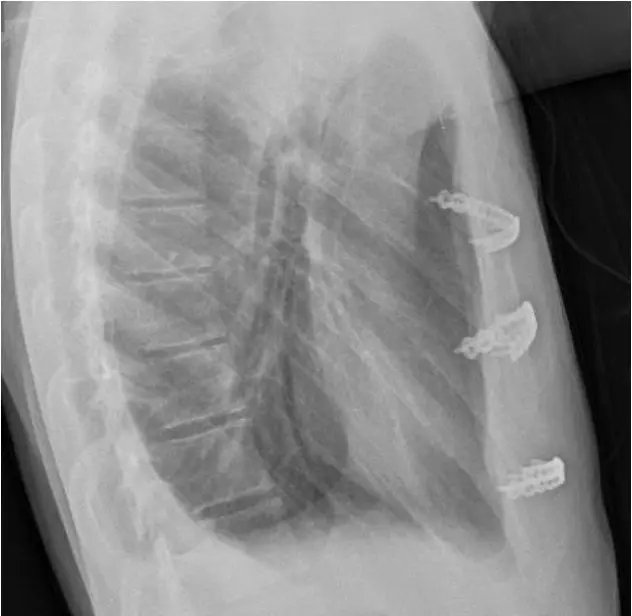 Modified Ravitch procedure for pectus carinatum correction