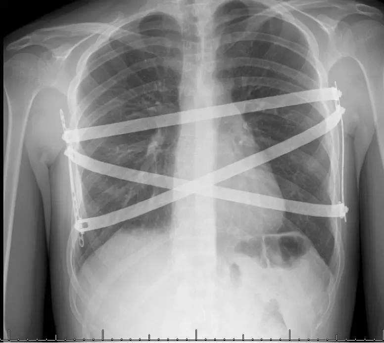 Nuss / MIRPE Procedure