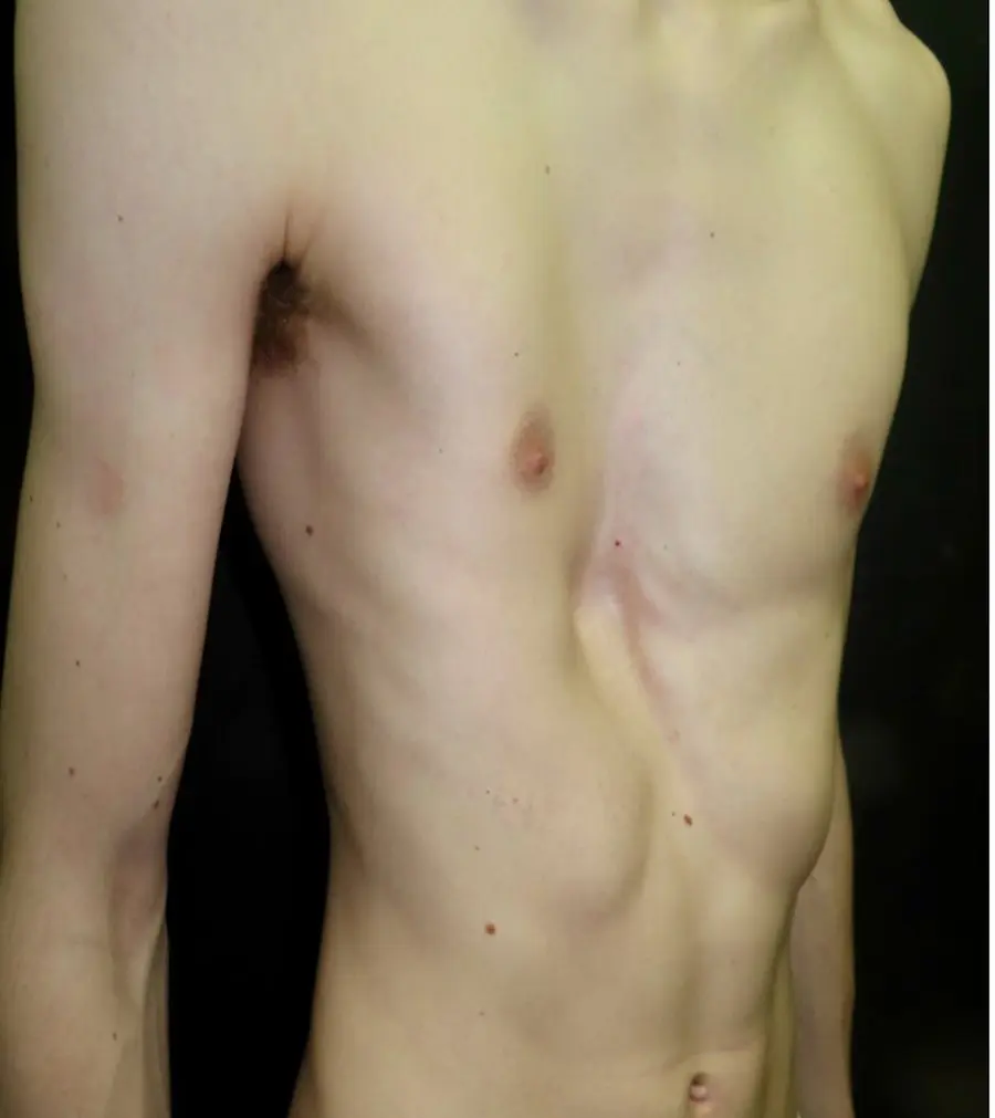 Lateral view of pectus excavatum deformity — Ravitch hybrid procedure