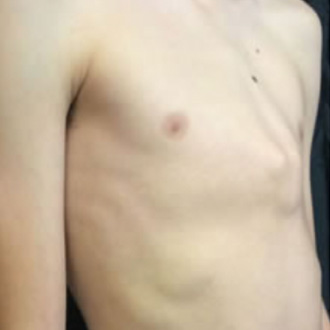 Pectus Carinatum