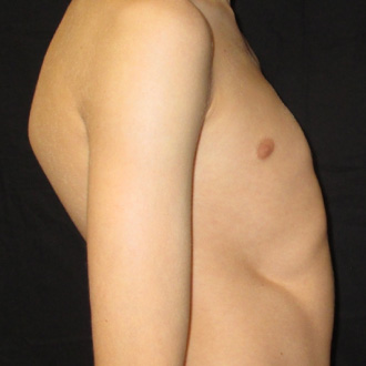 Pectus Posture