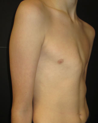 Moderate asymmetric right sided pectus carinatum deformity with mild contra...