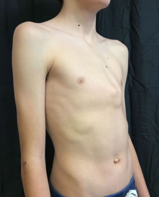 Pectus Carinatum.