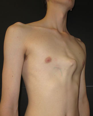 Pectus Carinatum