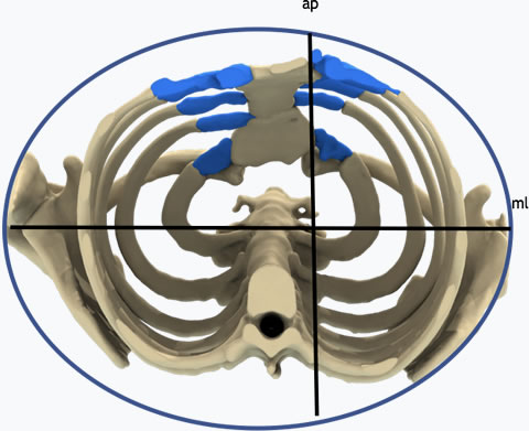 Pectus Carinatum Cross sectional Chest Wall Ratio