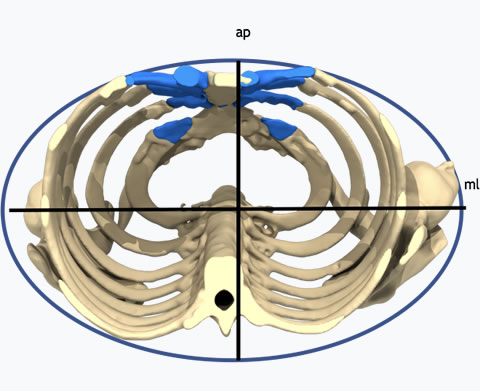 Pectus Carinatum Cross sectional Chest Wall Ratio