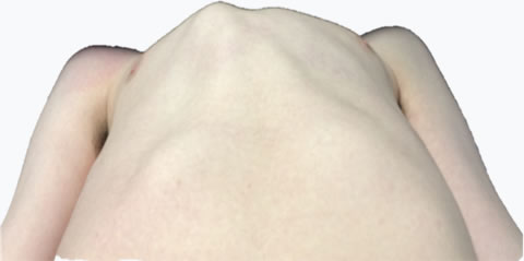 Pectus Carinatum Cross sectional Chest Wall Ratio