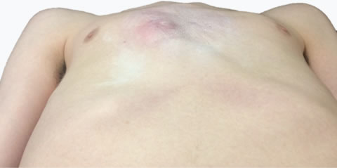 Pectus Carinatum Cross sectional Chest Wall Ratio