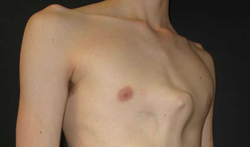 A young man with a severe symmetrical lower sternal pectus carinatum deform...