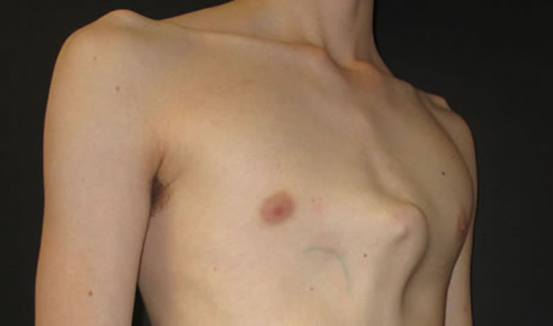 Pectus carinatum deformity