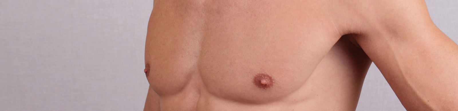 Pectus implants