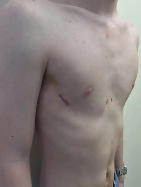 After compressed