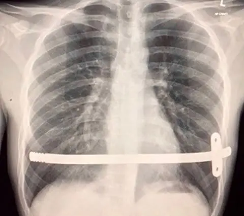 Xray