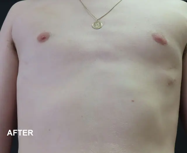 Cameron after Nuss Procedure pectus excavatum