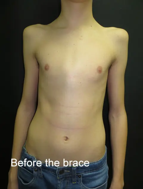 Before the brace