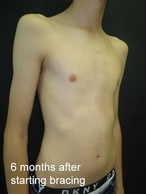 6 months after starting bracing