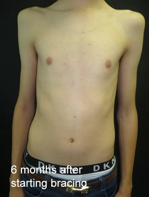 6 months after starting bracing