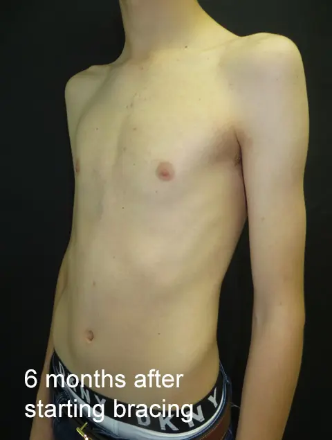 6 months after starting bracing