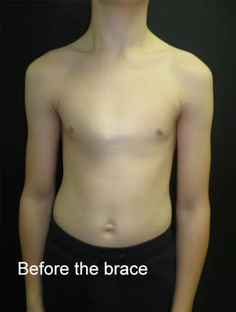 Before the brace