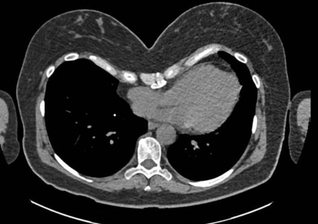Chest CT before corrective surgery for pectus excavatum
