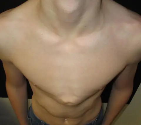 Before brace