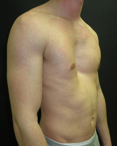 Before non-corrective surgery with pectus implant