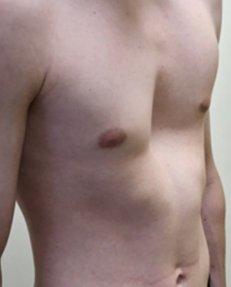 Before non-corrective surgery with pectus implant