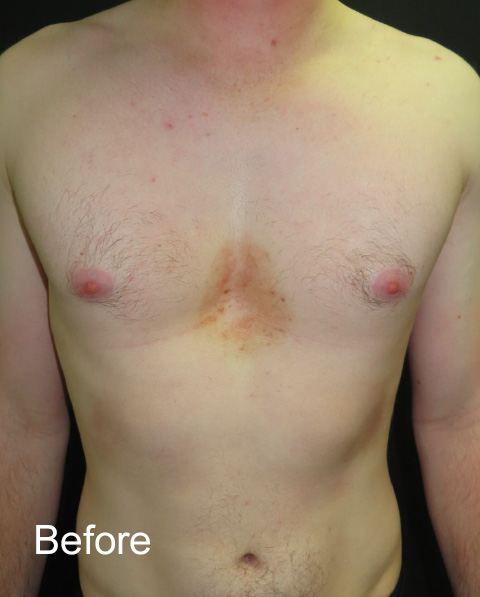 Before pectus non-corrective surgery with pectus implant