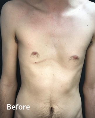 Before pectus non-corrective surgery with pectus implant inserted