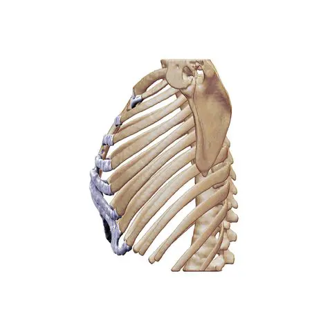 Side view of pectus carinatum showing sternal protrusion