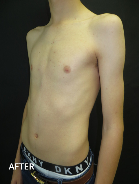 Brace - Modern, Medical Chest-Wall Brace for Pectus Carinatum - Tuvie  Design