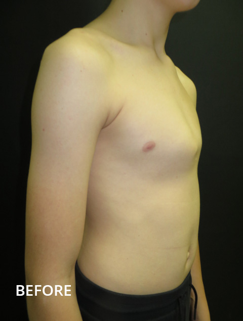 Bracing  Pectus Clinic