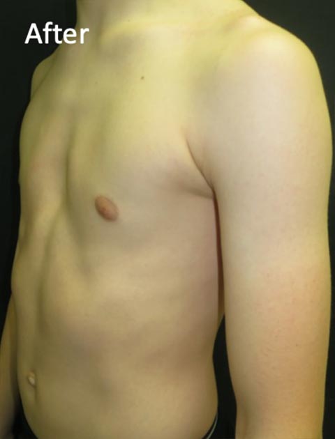 DIY Pectus and rib flare brace : r/PectusExcavatum