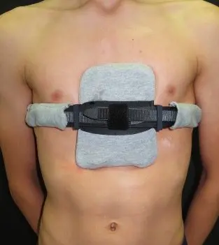 Custom chest wall brace for pectus carinatum — Pectus Clinic