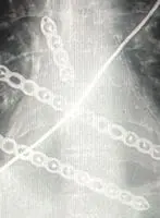Hybrid and combined chest wall reconstruction