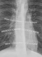 Modified Ravitch procedure for pectus carinatum