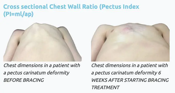 Pectus Index measurement — assessment tool for pectus carinatum
