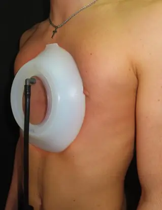 Vacuum bell therapy device — used alongside rib flare bracing for patients with pectus excavatum and rib flare