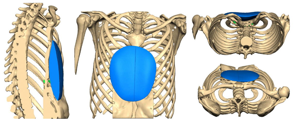 Chest CT reconstructions and planning scans of pectus implant