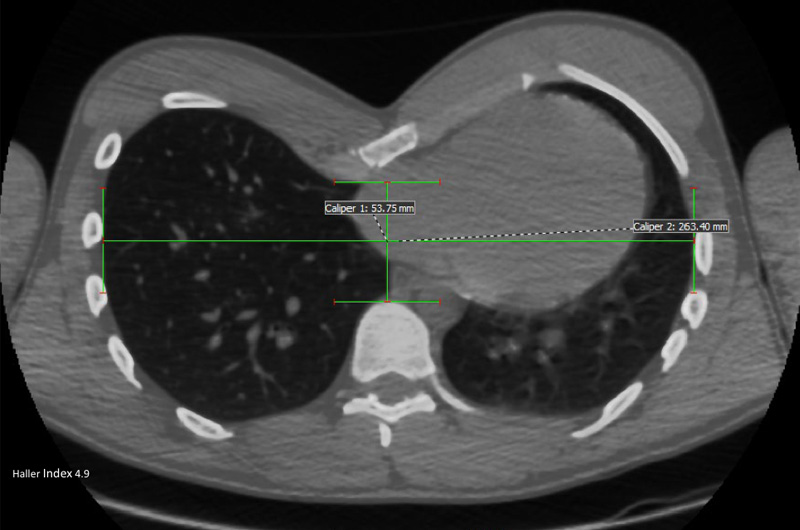 Chest CT scan of pectus excavatum