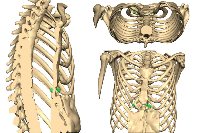 Chest CT scan reconstructions of chest