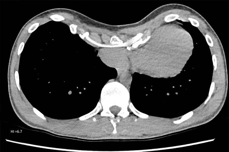 Chest CT scan residual pectus excavatum