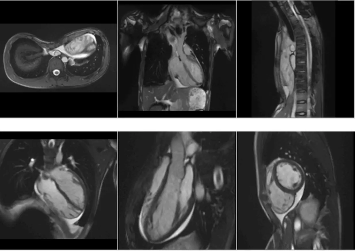 Cardiac MRI showing compression of the heart in severe pectus excavatum