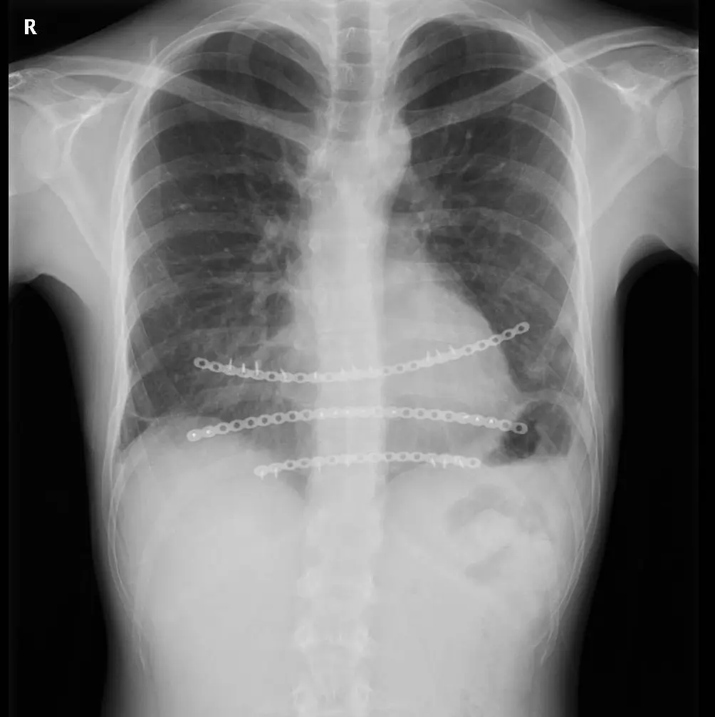 Complex and revision chest wall surgery — Pectus Clinic