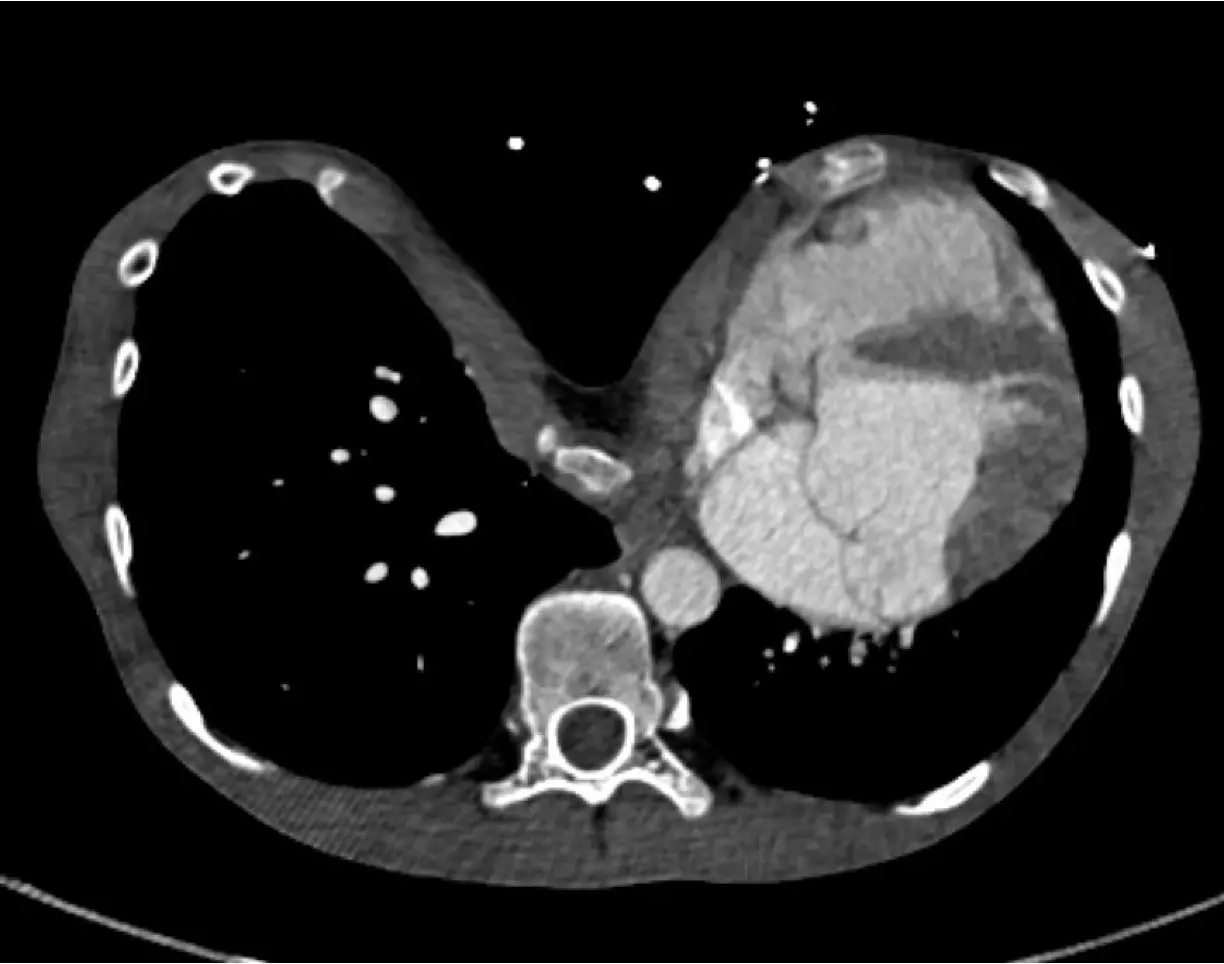 CT of an extreme pectus excavatum compressing the heart