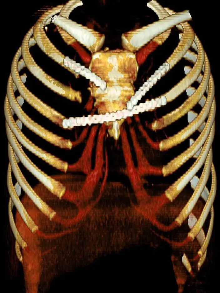 3D CT after revision, front view